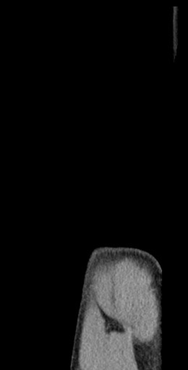 Schwarzes und weiße MRI-Bild eines Knies mit detaillierten anatomischen Strukturen.